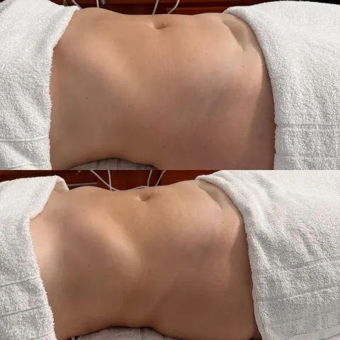 Comparación del abdomen antes y después de un tratamiento corporal