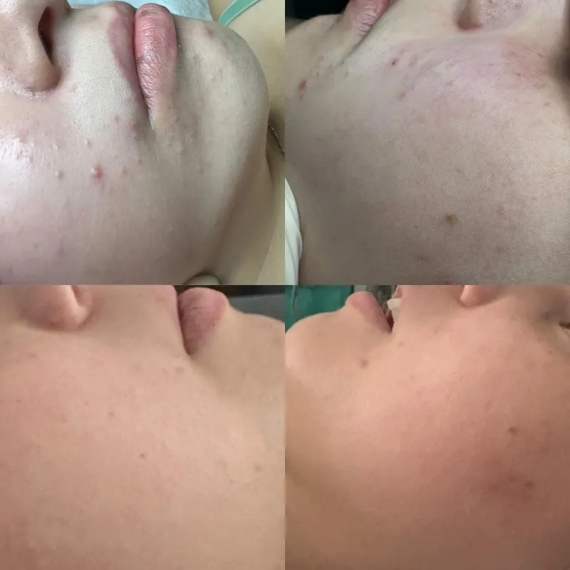 Antes y después de un tratamiento facial para el acné en mejilla y mentón